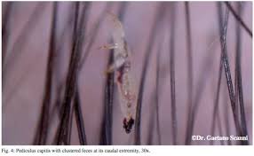 Bed Bug Black Bugs In Hair Not Lice Pin On Head Lice Facts