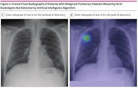 A doctor then uses a ct scanner to guide a needle through your skin into your lung to the site of a suspected. Ai Analysis Can Improve Lung Cancer Detection On Chest Radiographs Imaging Technology News