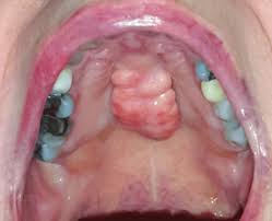 Image result for Mouth ulcers symptoms roof of the mouth