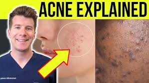 Image result for acne face