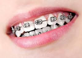 Bisikansehat Com Nbspthis Website Is For Sale Nbspbisikansehat Resources And Information Gigi Dental Kawat Gigi