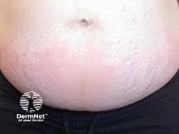 Image result for pruritic urticarial papules and plaques of pregnancy