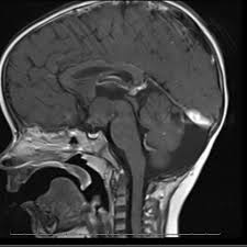 If you have problems viewing pdf files, download the latest version of adobe reader. Pallister Hall Syndrome Eurorad