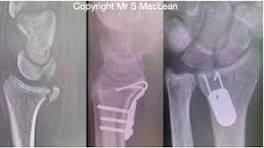 Volar marginal rim fractures of the distal radius ...