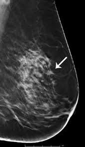 The rate of breast cancers discovered as dcis is thought to be increasing, but this is partially a testament to the effectiveness of mammographic breast cancer screening programs.ductal carcinoma in situ represents up to 30% of all new cases of breast cancer discovered by breast cancer screening. Breast Cancer Screening With 3d Mammography Or Tomosynthesis Radiology Imaging Ma Ct