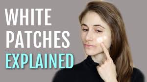 It is usually seen in children, and is most noticeable in those with darkly pigmented skin, although it may occur in all skin types. White Patches On The Face Explained Pityriasis Alba Dr Dray Dr Dray White Patches Dermatologist Doctor