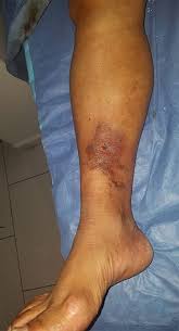 Image result for Lipodermatosclerosis