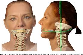 Baseline of upper teeth: (a) Control organ for spatial navigation? (b) Weak  point for misaligned posture and pain?