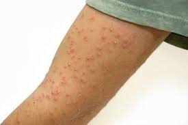 Bug Bites That Look Like Mosquito Bites But Aren T Insect Bite Identification Guide To Make Identifying Insect Bites Easy Wife And Mom In Training Insect Bites Identifying Insect Bites Insect Bite Identif