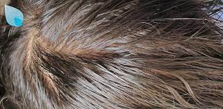 La problematica dei capelli grassi è legata ad una iperproduzione di sebo che oltre a diventare più abbondante varia anche la sua qualità, i processi di . Capelli Grassi E Capelli Unti Come Agire Per Risolvere Il Problema Hairclinic