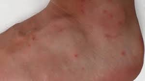 Image result for scabies bite