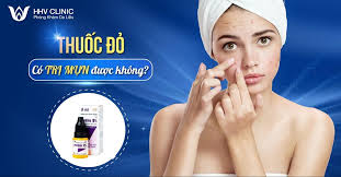 Hỏi - đáp] Thuốc đỏ trị mụn có được không, có tốt không?