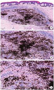 Image result for Blue Nevus