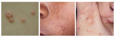 Zymaderm is 100% guaranteed to eliminate molluscum or your money back. Molluscum Contagiosum Treatment Symptoms Stages Home Remedies