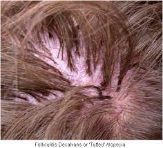 Thus, diseases that lead to hair loss (alopecia), structural hair shaft defects or excessive hair growth on the hair growth disorders caused by structural hair shaft defects can be acquired or inherited. Rare Hair Loss Conditions