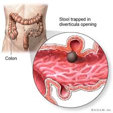 It should not be mistaken for a pericolic abscess and, where there is the slightest doubt, percutaneous drainage should be contraindicated. Surgery For Diverticulosis And Diverticulitis Santa Monica Ca Encino Ca