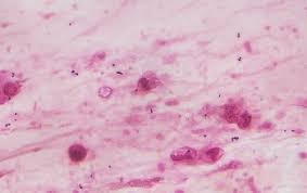 Image result for Rhodococcus equi