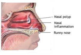 The nasal blockage, stuffy nose, sneezing, supra orbital pain, runny nose can be cured successfully with homeopathy treatment. Nasal Polyp Causes Treatment In Homeopathy Dr Thind