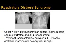 On imaging, the condition generally presents as bilateral and relatively symmetric diffus. Respiratory Distress In The Newborn Ppt Download
