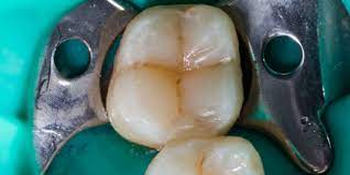 For people who have delayed their dental treatment for a long time and require extractions, dental implants in arcadia may be the next best step. What Does A Cavity Look Like How To Tell If You Have A Cavity