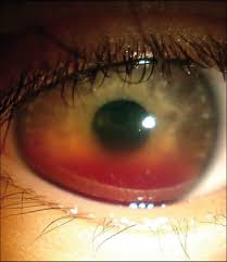Image result for Hyphema