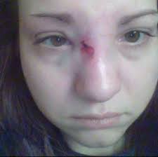 Has anyone had a broken finger heal