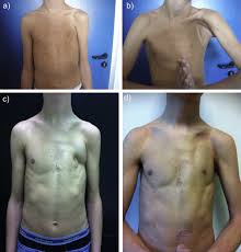 Poland's syndrome , in the classic sense, is the unilateral absence of the sternocostal head of the pectoralis major muscle, ipsilateral breast hypoplasia, and a concomitant, ipsilateral hand deformity. Laparoscopically Harvested Omental Flap For Breast Reconstruction In Poland Syndrome Sciencedirect