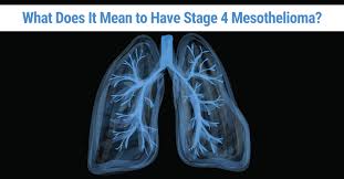 cancer develops locally or regionally up to stage 3. Stage 4 Mesothelioma Life Expectancy Palliative Treatments