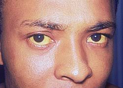 Hepatitis ini penyakit yang bisa nyerang semua orang. Hepatitis A Wikipedia Bahasa Melayu Ensiklopedia Bebas