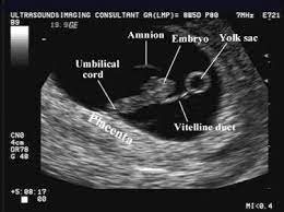 Fetal Anomalies Associated With Breech Presentation Obstetric Ultrasound Ultrasound Sonography Ultrasound School