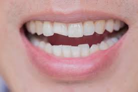 How much does it cost to repair a chipped tooth? Chipped Tooth Repair Cost East Valley Dental Professionals