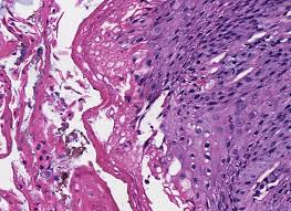Esophagitis can cause painful, difficult swallowing and chest pain. Pathology Outlines Esophagitis Dissecans Superficialis