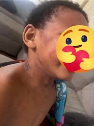 Eosinophilic esophagitis treatment with dupixent