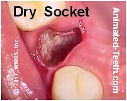 Natural remedies for pain following a dental extraction can bring a surprising amount of pain relief, without the risk of side using tea bags several times a day on the first day can often prevent swelling and promote healing. Dry Socket Signs Symptoms Pictures How Long Do They Last Healing Times Why Do They Form