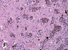 Read more about melanoma skin cancer morphoeic basal cell cancer The Hallmarks Of Cancer Wikipedia