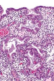 Endometriosis is a painful condition in which endometrial tissue grows outside the uterus, often in the pelvic area. Secretory Phase Endometrium Libre Pathology