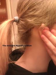 T4 only thyroid medications can cause hair loss as a negative side effect of taking the medication. Pin On Thyroid Thoughts