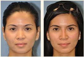 Permanent Non Surgical Nose Job Nonsurgical Nose Job Nose Fillers Nose Job