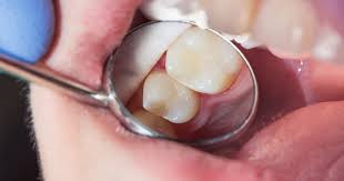 Bacteria causes cavities to get worse. What Does A Cavity Look Like Mint Hill Dentistry