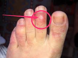To help prevent an ingrown toenail: Covid Toes The Latest Unusual Symptom In Coronavirus Patients