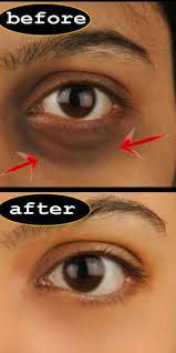 Dark Circles And How To Remove Them Permanently Skincare Skin Facewash Remedies Dark Circle Remedies Spots On Face Dark Circles Treatment