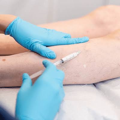 Sclerotherapy Cost in Dubai | Starting From 599 AED