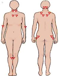 The physical examination is remarkable for tenderness, particularly in specific. Fibromyalgia The Tender Points On The Body