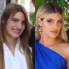 Cosmetic Dermwhat Do You Think Lele Pons Had Done To Her Face Rhinoplasty Aesthetic Dermatology Cosmetic Dermatology
