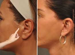 During the postoperative period following a facelift, caudal extension of the earlobe secondary to pulling of the submandibular tissues can occur. How To Spot A Bad Face Lift
