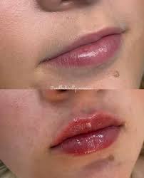 Ana Paula Aun, MMS, PA-C (@aesthetically_anaaun) • Instagram photos and  videos