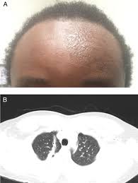 Image result for Anhidrosis