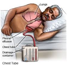 Image result for Chest Tube