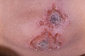 Image result for Impetigo