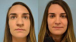 Be part of something exceptional. Nose Surgery Before After Photos Patient 160 San Francisco Ca Kaiser Permanente Cosmetic Services